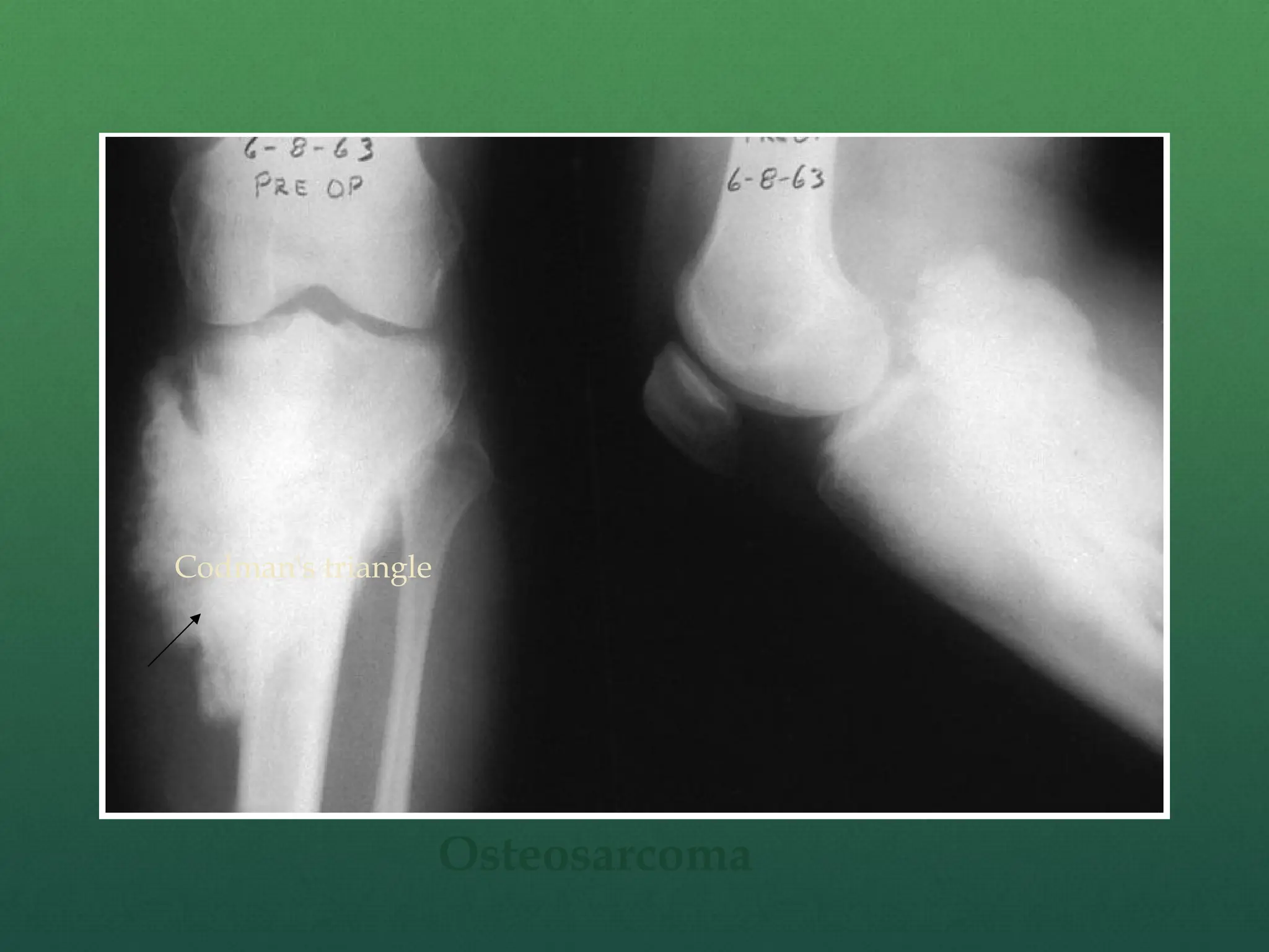 Codman's triangle
Osteosarcoma
 