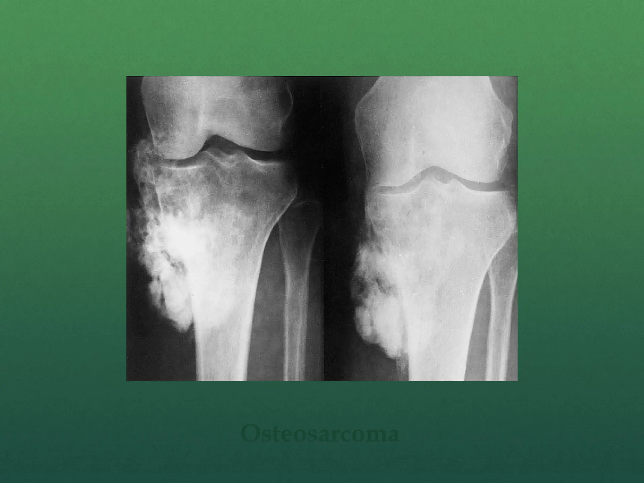 Osteosarcoma
 