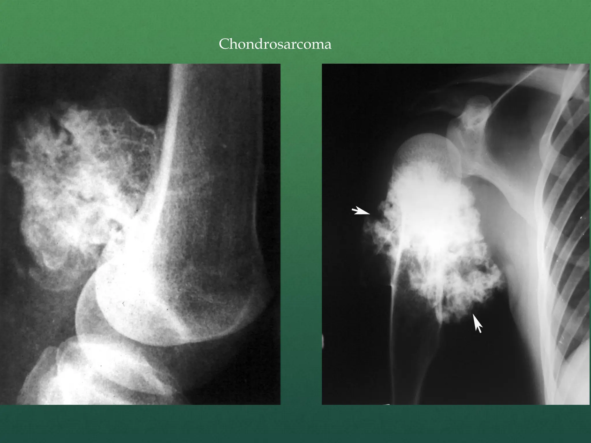 Chondrosarcoma
 