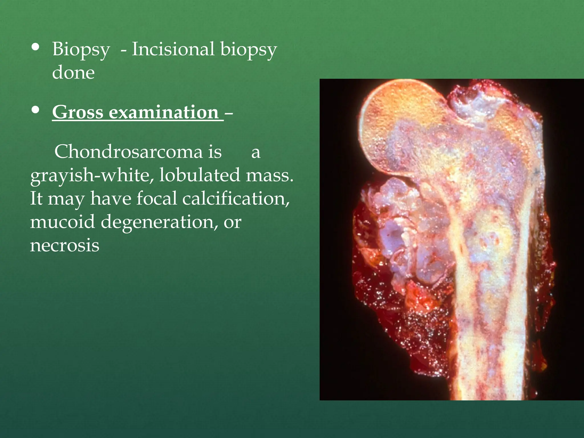  Biopsy - Incisional biopsy
done
 Gross examination –
Chondrosarcoma is a
grayish-white, lobulated mass.
It may have focal calcification,
mucoid degeneration, or
necrosis
 