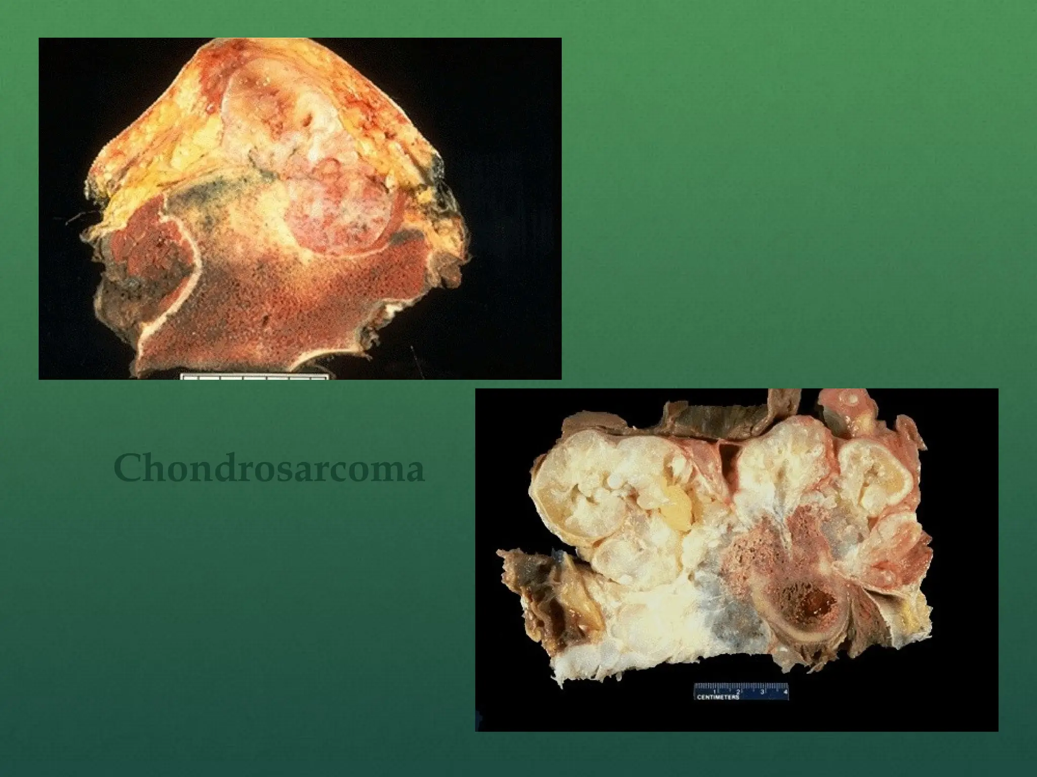 Chondrosarcoma
 