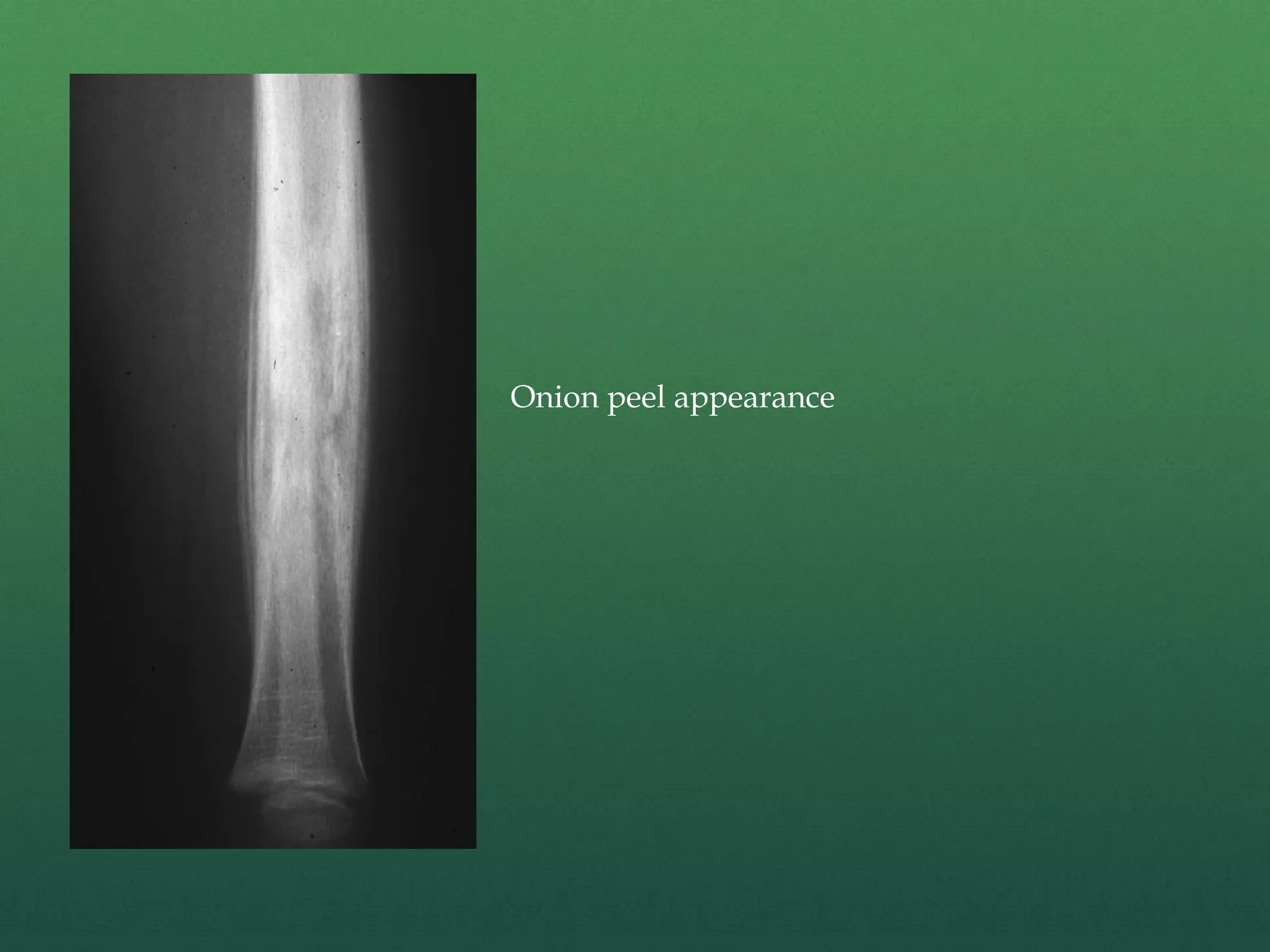 Onion peel appearance
 