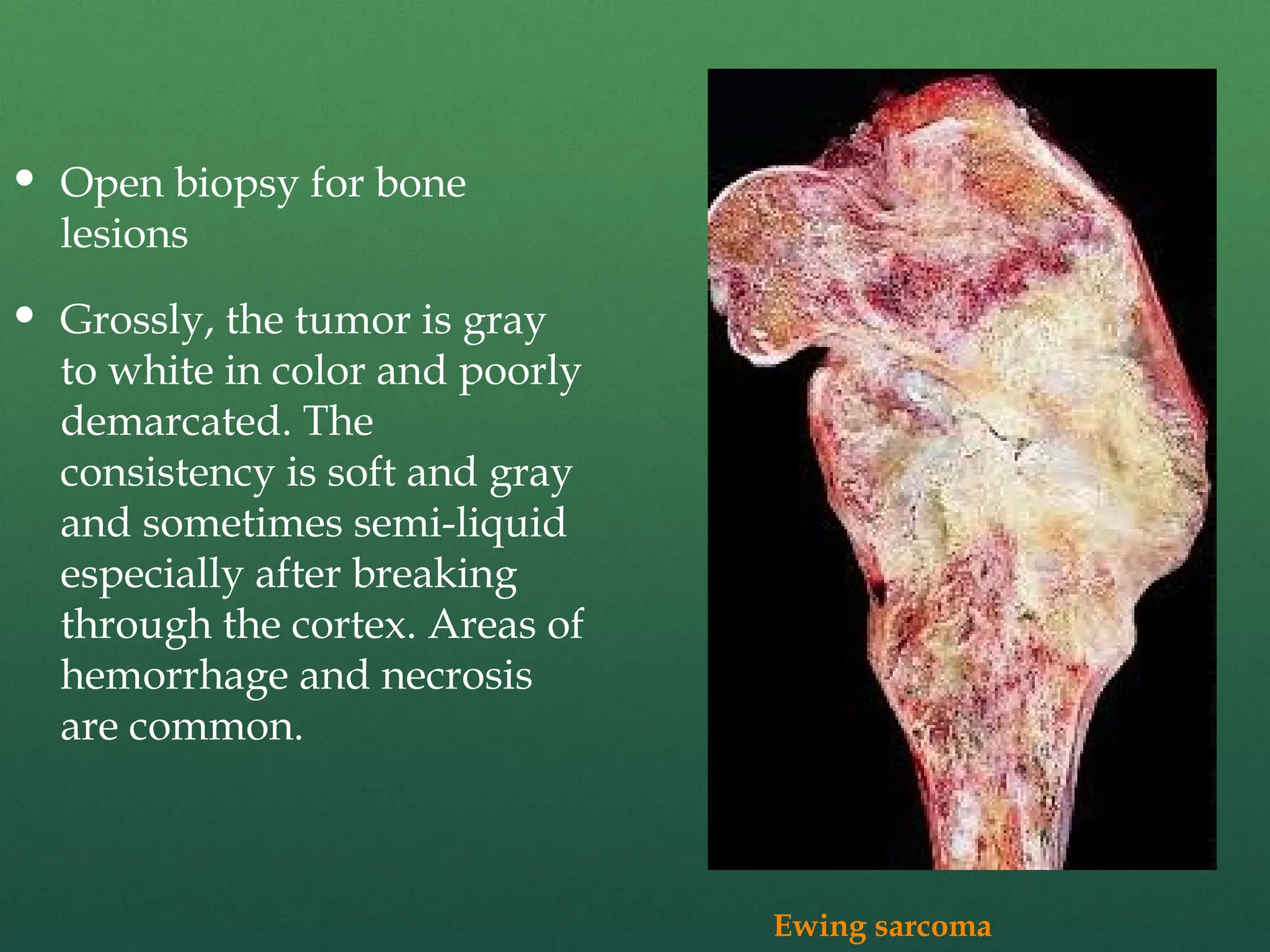  Open biopsy for bone
lesions
 Grossly, the tumor is gray
to white in color and poorly
demarcated. The
consistency is soft and gray
and sometimes semi-liquid
especially after breaking
through the cortex. Areas of
hemorrhage and necrosis
are common.
Ewing sarcoma
 
