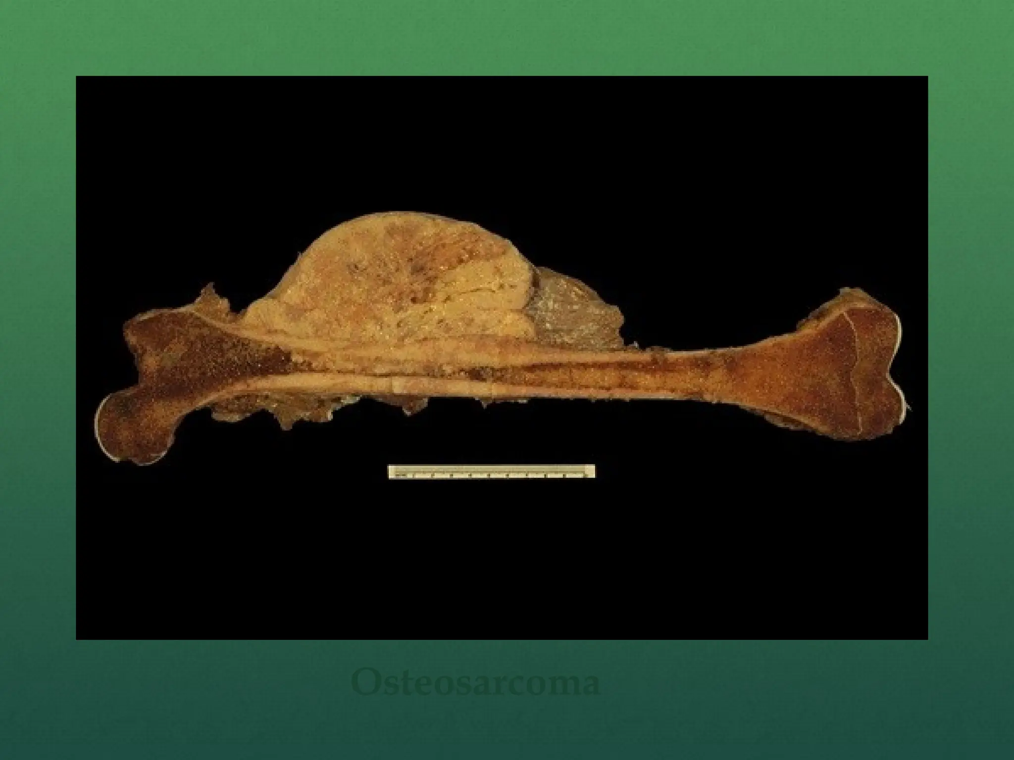 Osteosarcoma
 