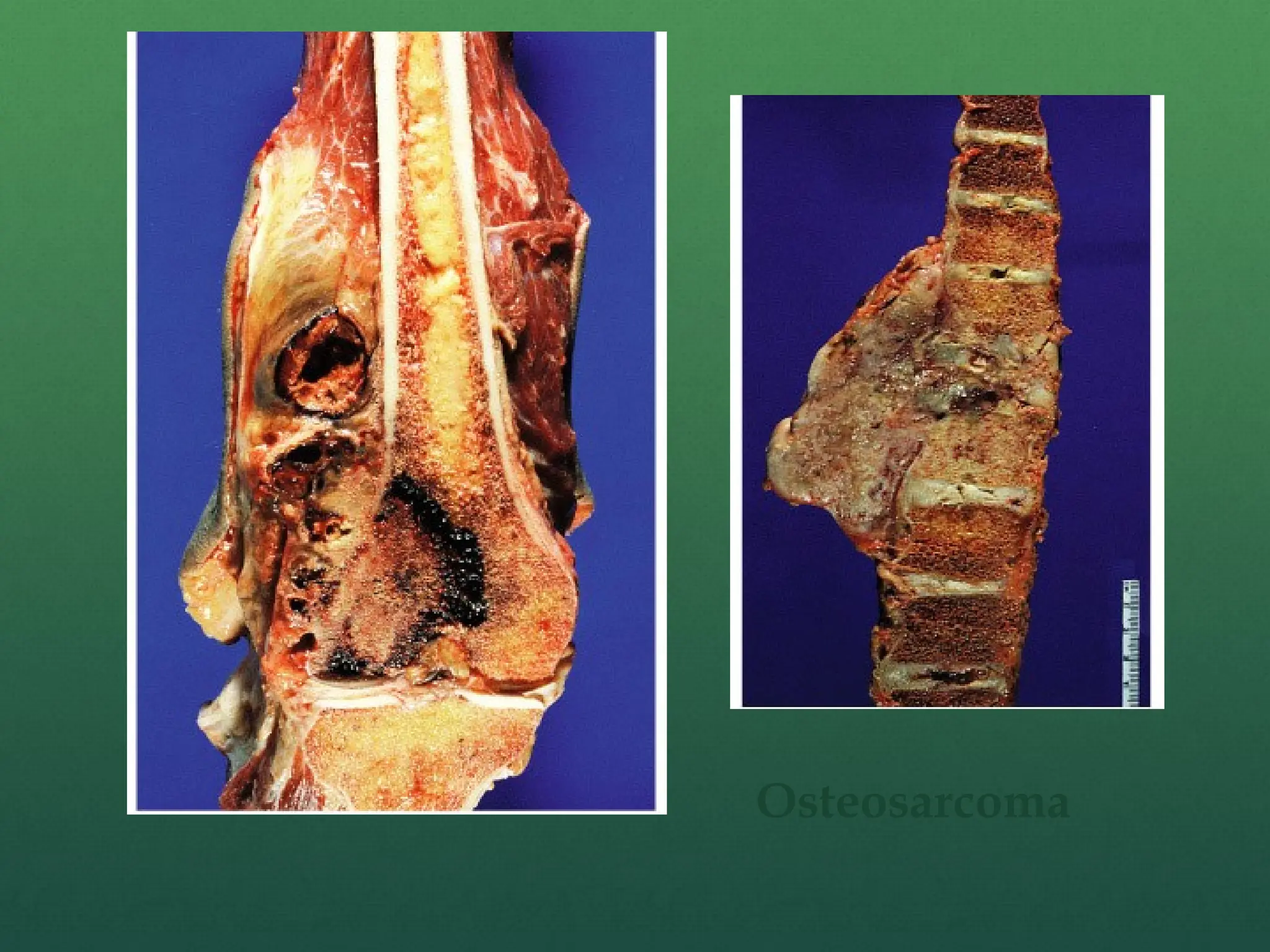 Osteosarcoma
 