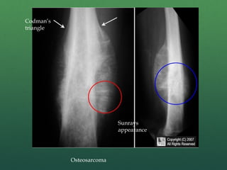 bone_tm3 2.pptx bone tumors discussion d | PPTX