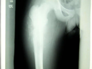 Bone tumor radiological approach Slide 45