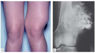 ANEURYSMAL BONE CYST
Occurs chiefly in the spine and the metaphyses of
long bones, It may expand the bone and cause marke...
