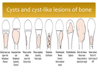 Cysts and cyst-like lesions of bone
 