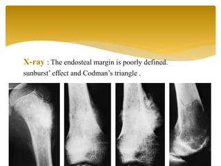 X-ray : The endosteal margin is poorly defined.
sunburst’ effect and Codman’s triangle .
 