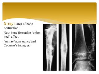 X-ray : area of bone
destruction
New bone formation ‘onion-
peel’ effect.
‘sunray’ appearance and
Codman’s triangles.
 