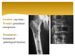 Location : any bone .
X-rays: generalized
osteoporosis .
Treatment :
treatment of
pathological fractures
 