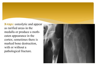 X-rays : osteolytic and appear
as rarified areas in the
medulla or produce a moth-
eaten appearance in the
cortex; sometimes there is
marked bone destruction,
with or without a
pathological fracture.
 