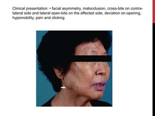 Clinical presentation: • facial asymmetry, malocclusion, cross-bite on contra-
lateral side and lateral open-bite on the affected side, deviation on opening,
hypomobility, pain and clicking
 