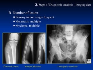 Bone Tumor And Tumor Like Diseases | PPT