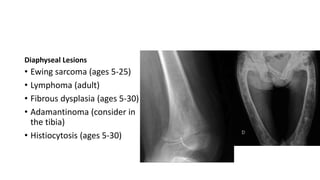 • Ewing sarcoma (ages 5-25)
• Lymphoma (adult)
• Fibrous dysplasia (ages 5-30)
• Adamantinoma (consider in
the tibia)
• Histiocytosis (ages 5-30)
Diaphyseal Lesions
 