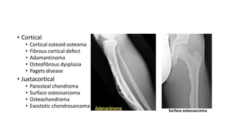 • Cortical
• Cortical osteoid osteoma
• Fibrous cortical defect
• Adamantinoma
• Osteofibrous dysplasia
• Pagets disease
• Juxtacortical
• Parosteal chondroma
• Surface osteosarcoma
• Osteochondroma
• Exostotic chondrosarcoma
Surface osteosarcoma
 