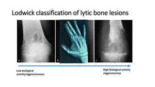 Lodwick classification of lytic bone lesions
Low biological
activity/aggressiveness
High biological activity
/aggresiveness
 