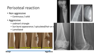 Perisoteal reaction
• Non aggressive
• Continuous / solid
• Aggressive
• codman’s triangle
• Sun burst appearance / spiculated/hair on end
• Lamellated
Benign Aggressive
 