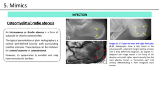 bone tumor ppt.pptx including osteosarcoma | PPTX