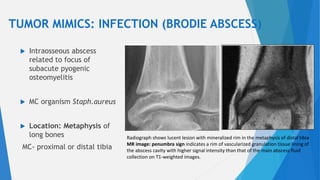 Tibia Abscess bone tumors-1.pptx