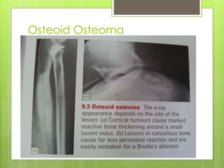 Osteoid Osteoma
 