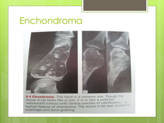 Enchondroma
 