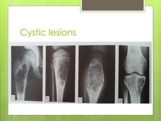Cystic lesions
 