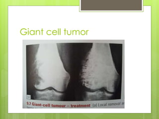Giant cell tumor
 
