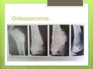 Osteosarcoma
 