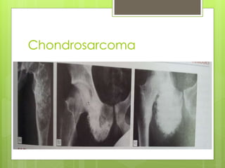 Chondrosarcoma
 