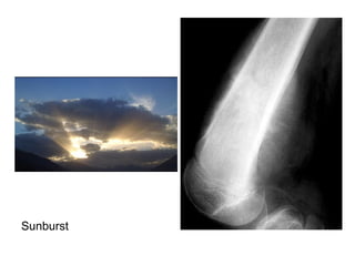 Diagnostic Imaging of Bone Tumors | PPT