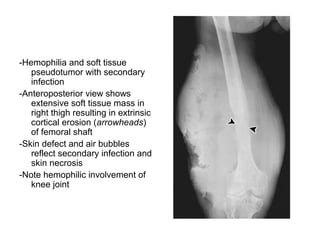 Diagnostic Imaging of Bone Tumors