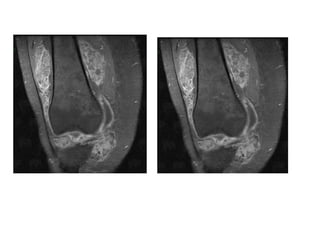 Diagnostic Imaging of Bone Tumors