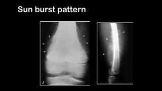 Bone tumors | PDF