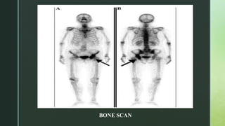 Bone tumors.pptx