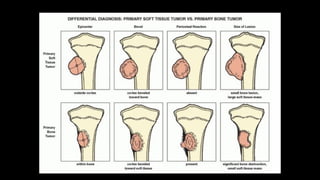 Bone tumors and tumor like lesions .pptx