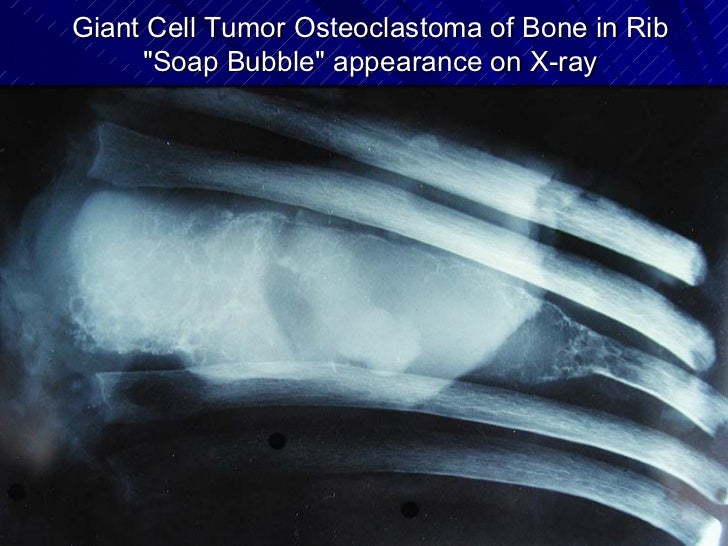 Bone Tumors Benign Ppt