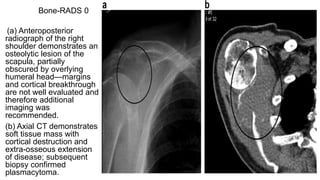 bone tumors final presentation in different sce | PPTX