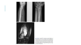 Bone tumors part 2 | PPT