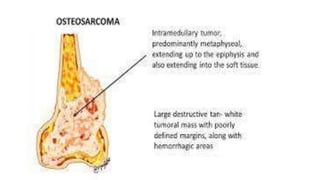 BONE TUMORS PPT malignant and benign for study | PPTX