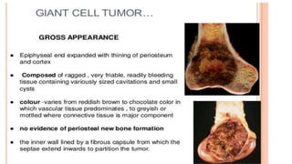 BONE TUMORS PPT malignant and benign for study | PPTX