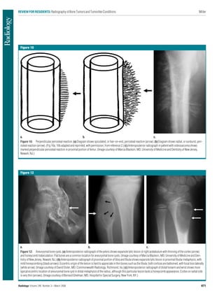 bone tumors x ray.pdfThis comprehensive review by Dr. Theodore T ...