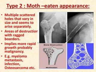 Type 2 : Moth –eaten appearance:
• Multiple scattered
holes that vary in
size and seems to
arise separately.
• Areas of destruction
with ragged
boarders.
• Implies more rapid
growth probably
malignancy.
• E.g. myeloma
metastasis,
infection,
Osteosarcoma etc.
 