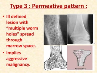 Type 3 : Permeative pattern :
• Ill defined
lesion with
“multiple worm
holes” spread
through
marrow space.
• Implies
aggressive
malignancy.
 