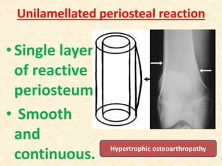Unilamellated periosteal reaction
•Single layer
of reactive
periosteum.
• Smooth
and
continuous. Hypertrophic osteoarthropathy
 