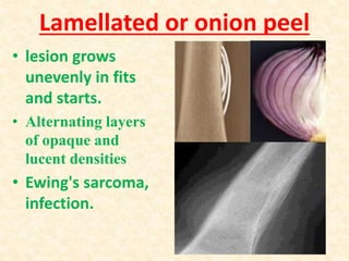 Lamellated or onion peel
• lesion grows
unevenly in fits
and starts.
• Alternating layers
of opaque and
lucent densities
• Ewing's sarcoma,
infection.
 