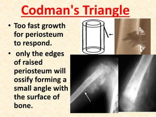 Codman's Triangle
• Too fast growth
for periosteum
to respond.
• only the edges
of raised
periosteum will
ossify forming a
small angle with
the surface of
bone.
 