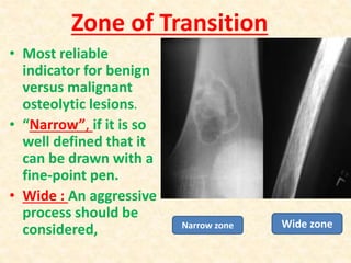 Zone of Transition
• Most reliable
indicator for benign
versus malignant
osteolytic lesions.
• “Narrow”, if it is so
well defined that it
can be drawn with a
fine-point pen.
• Wide : An aggressive
process should be
considered, Narrow zone Wide zone
 