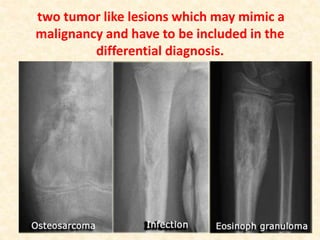 two tumor like lesions which may mimic a
malignancy and have to be included in the
differential diagnosis.
 
